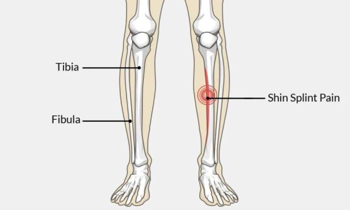 Shin splint leg pain knee injury Sport Lower tibia strain tendon muscle  fall impact trauma bone