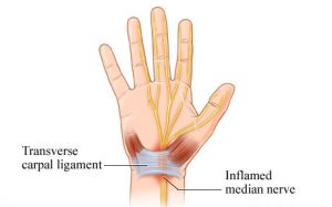 Taking a Look at Carpal Tunnel Syndrome 1