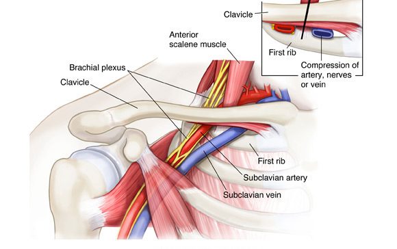 Thoracic Outlet Syndrome Core Healthcare