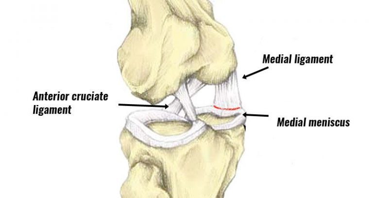 Medial Meniscal Tears - Core Healthcare