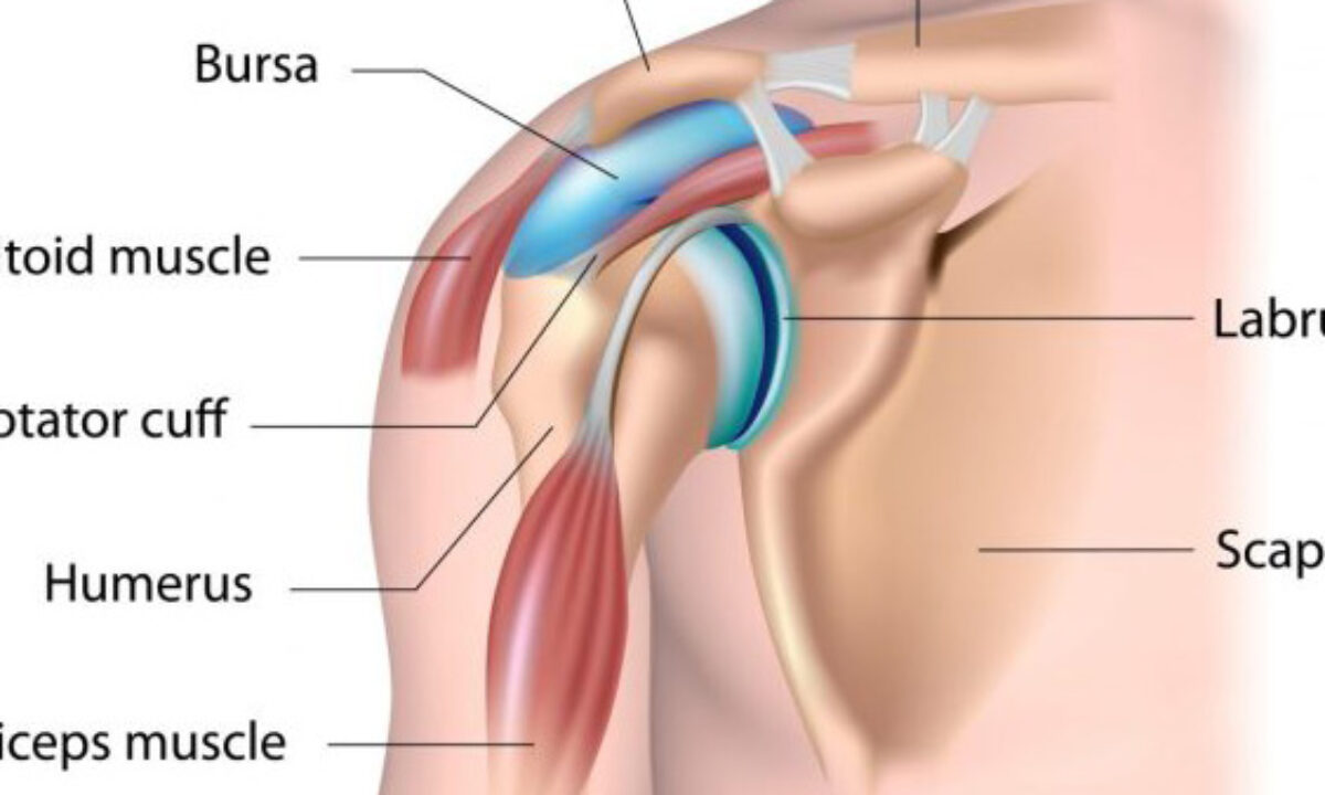 Bursitis