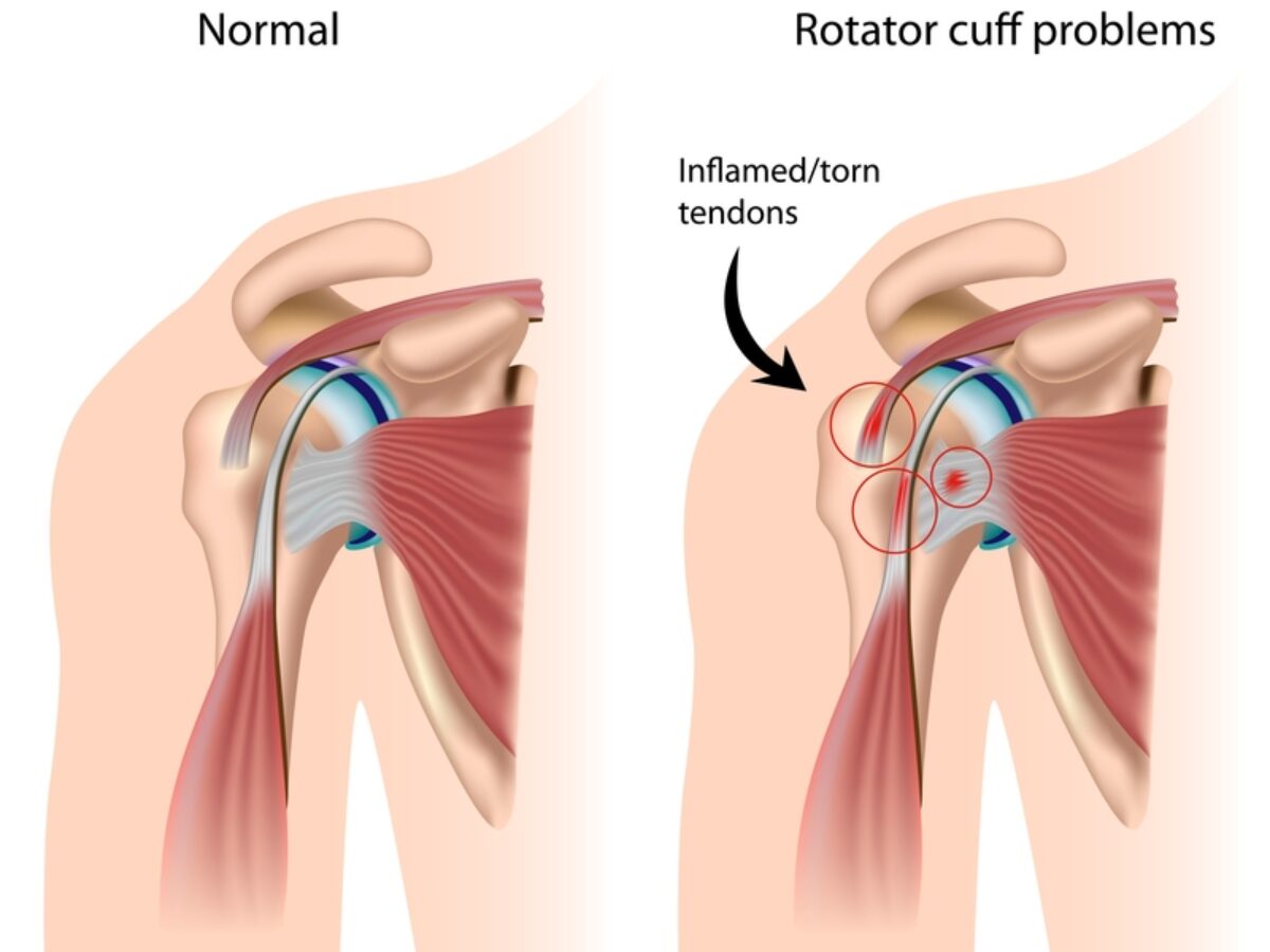 Rotator Cuff Tendinitis Exercises