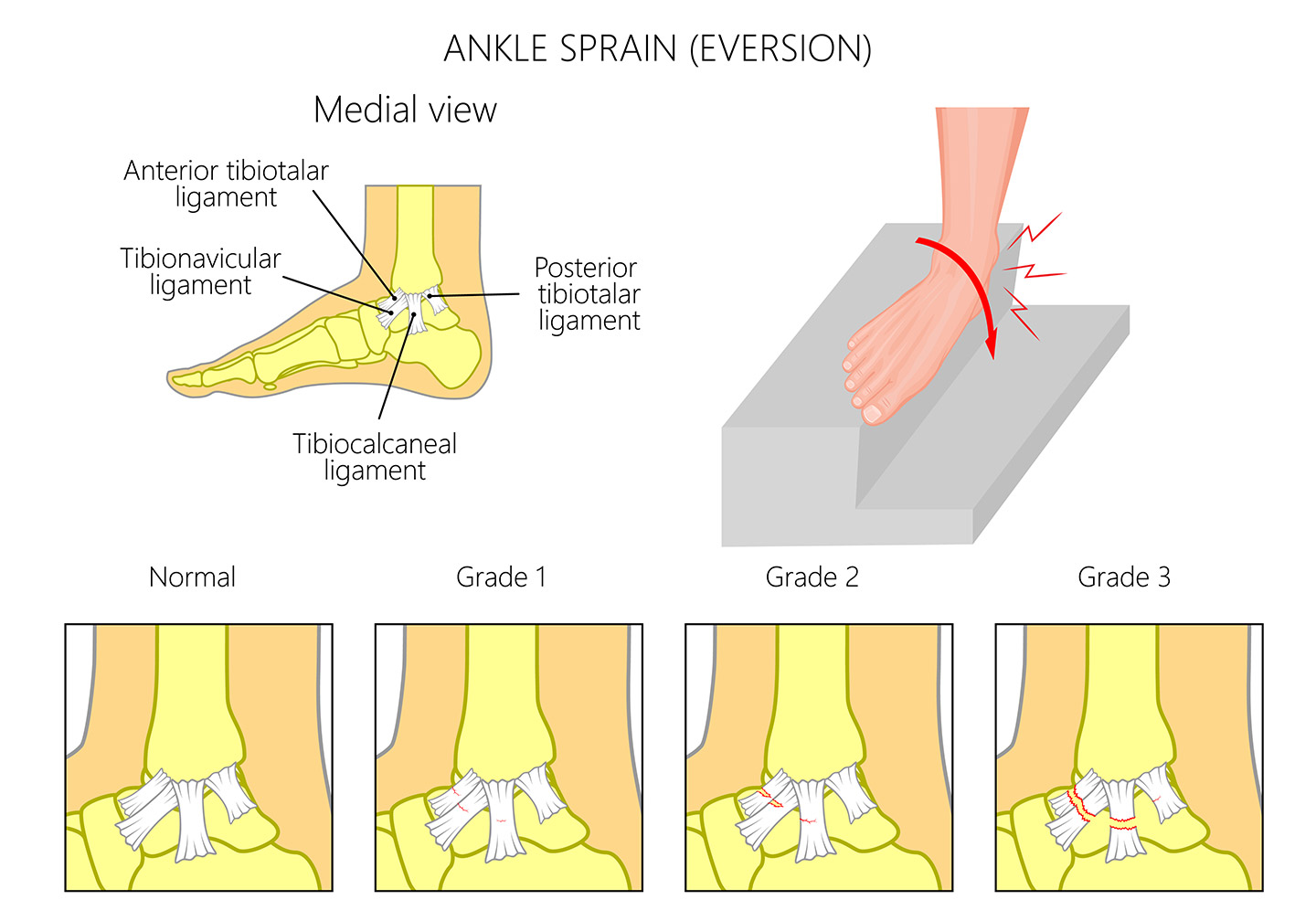 Inside-of-ankle pain after a sprain — what should I know? 2 Inside-of-ankle pain after a sprain