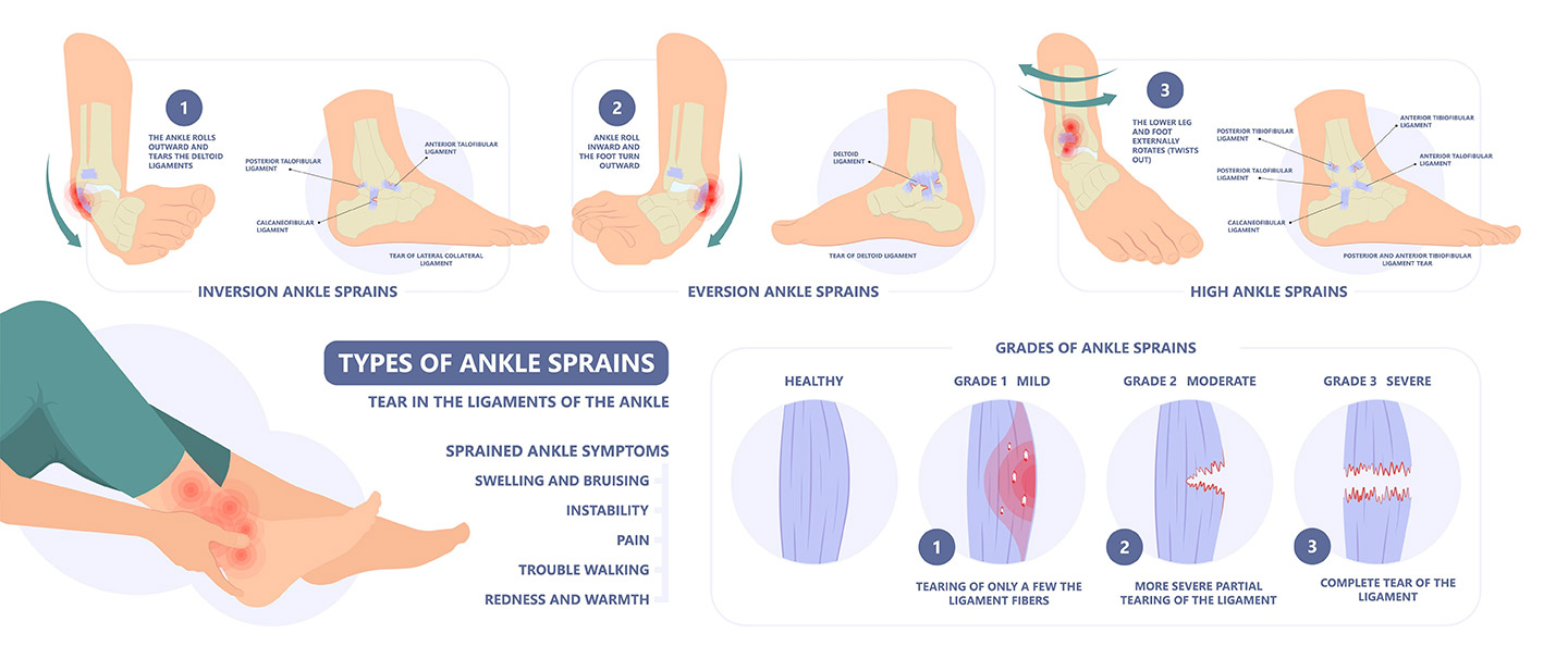 My ankle keeps giving way months after a sprain