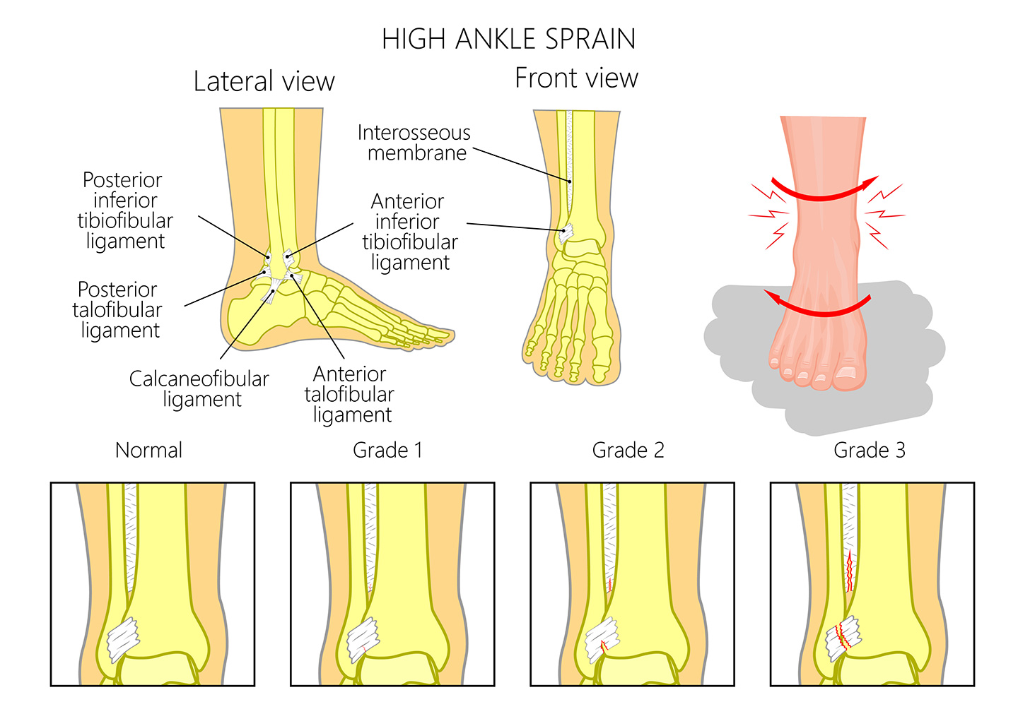 Ankle pain above the joint after rolling it - what could it be? 2 Why Am I Not Recovering Between Training Sessions?