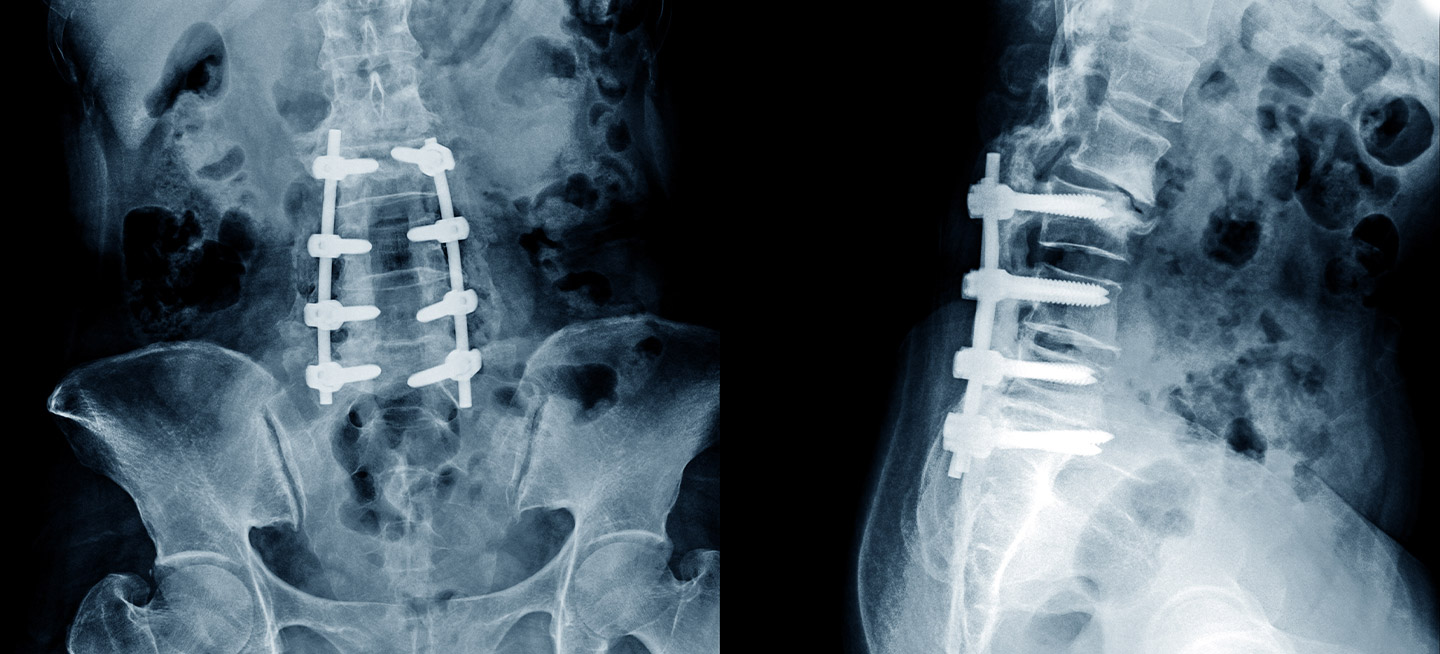 Recurrence is extremely common with back pain