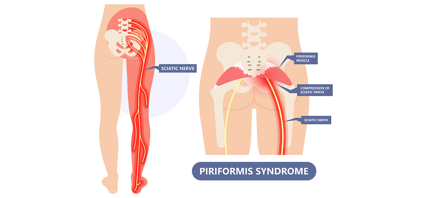 Coccygeal pain