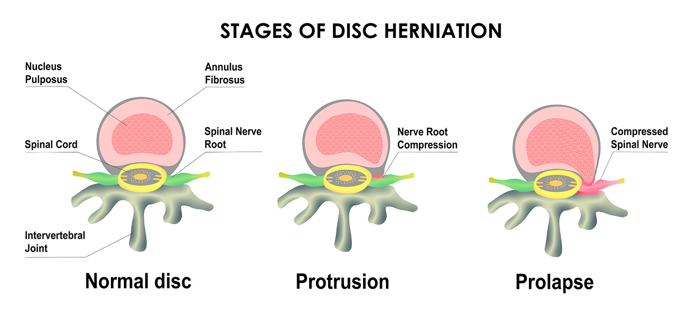 Stages of a disc bulge