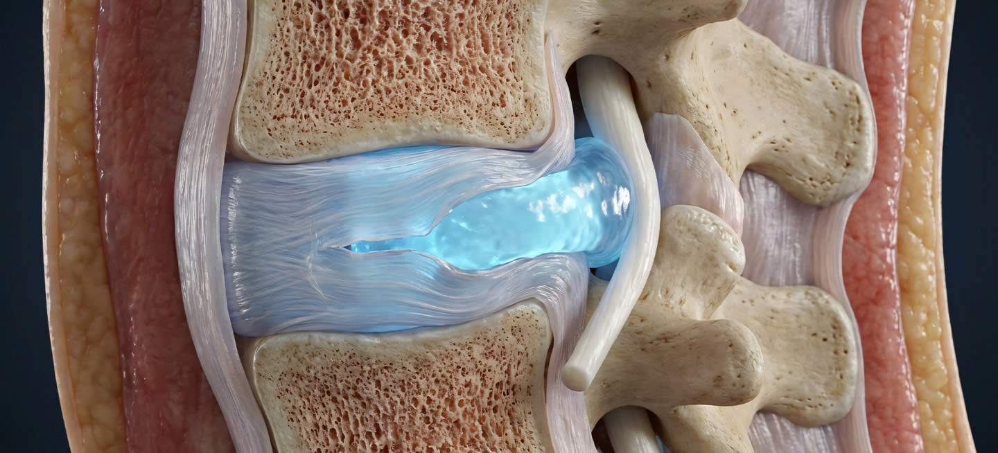 Disc degeneration — should I be worried? 2 Disc degeneration