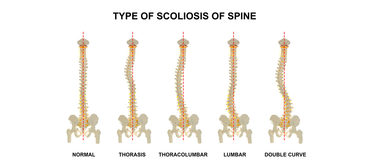 Curvature of the spine
